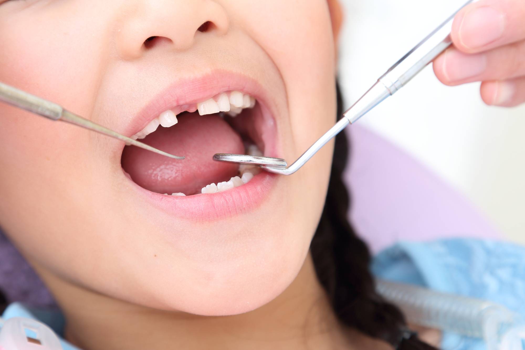 乳歯の虫歯治療