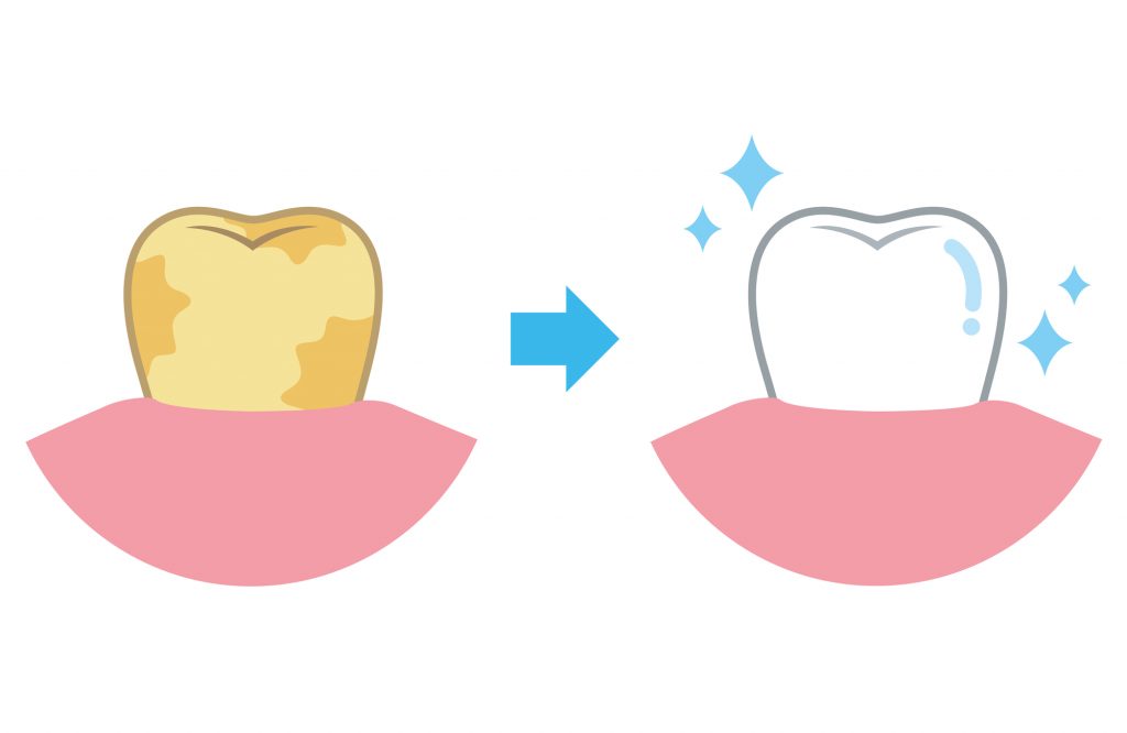 歯のホワイトニングの種類とその仕組みとは？ | デンタルブログ｜お口のお悩みの原因と対策｜すべての健康は歯から