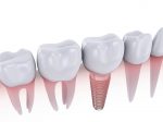 前歯のインプラントの色の選び方のコツ
