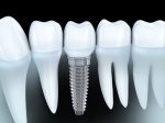 前歯のインプラントの難易度・成功率とは？