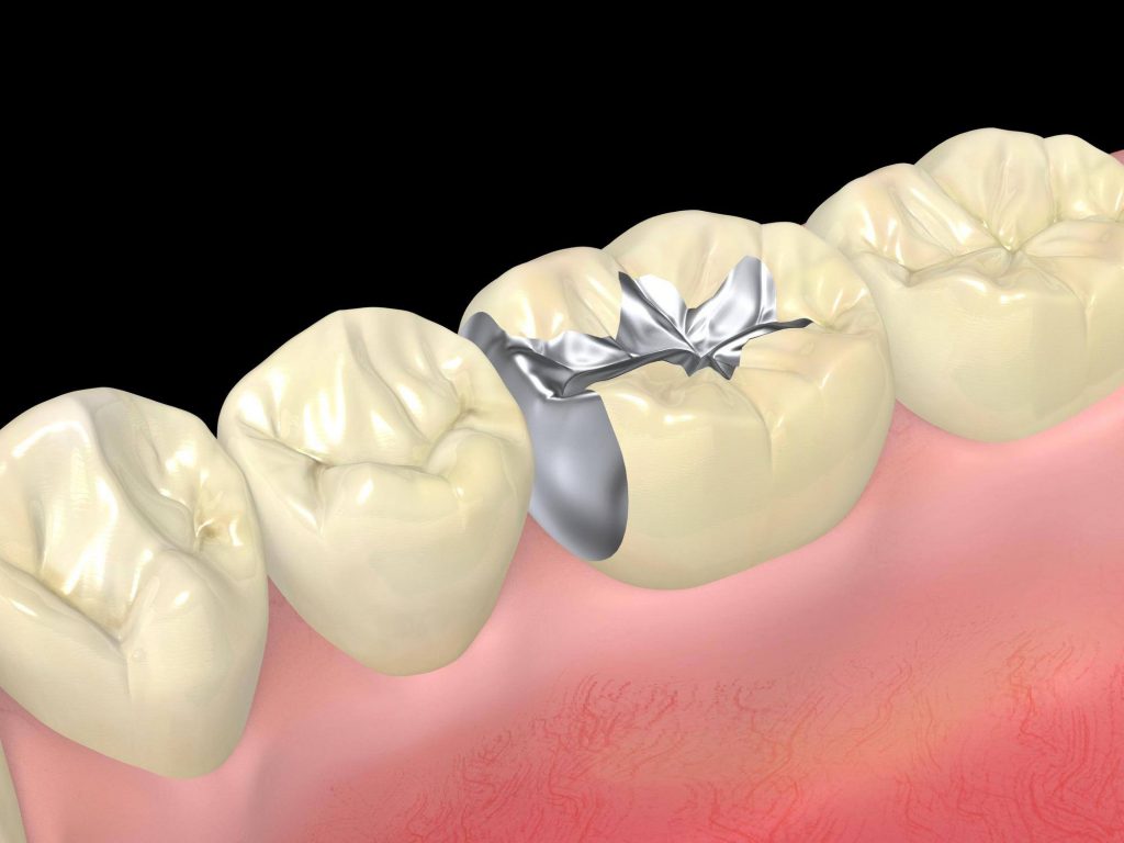 銀歯の下や中、詰め物の下を虫歯にしない予防方法とは？