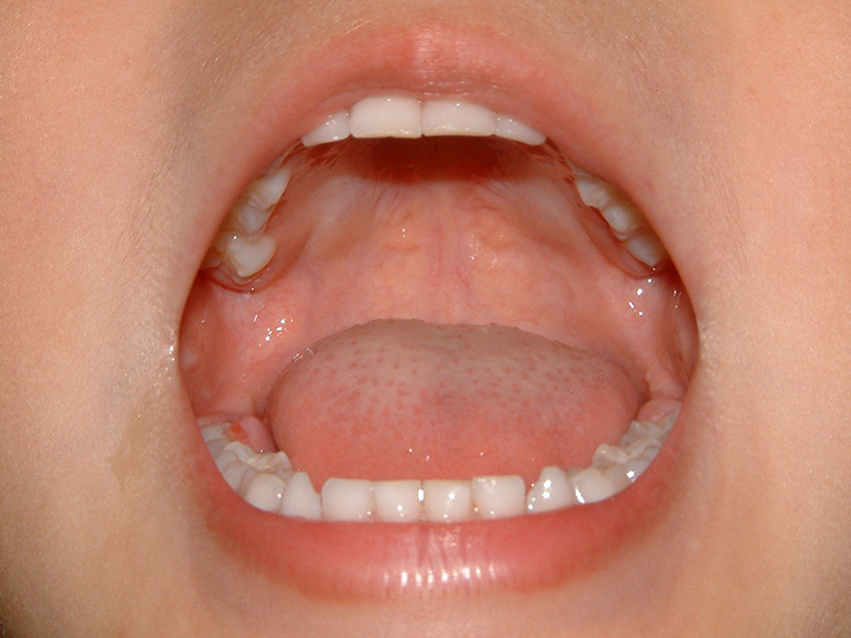 黒毛舌の原因と対策